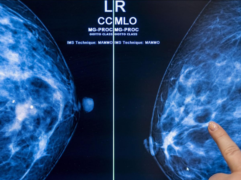 L’IA prédit le risque de cancer du sein plusieurs années à l’avance