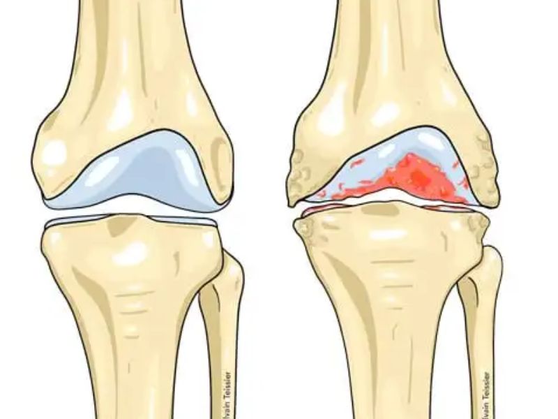Traitement de l’arthrose : des résultats prometteurs pour une solution durable