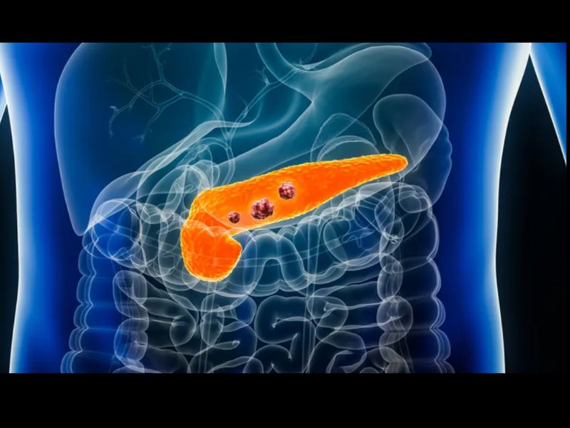 Un nouveau médicament expérimental double le taux de survie des patients atteints de cancer du pancréas