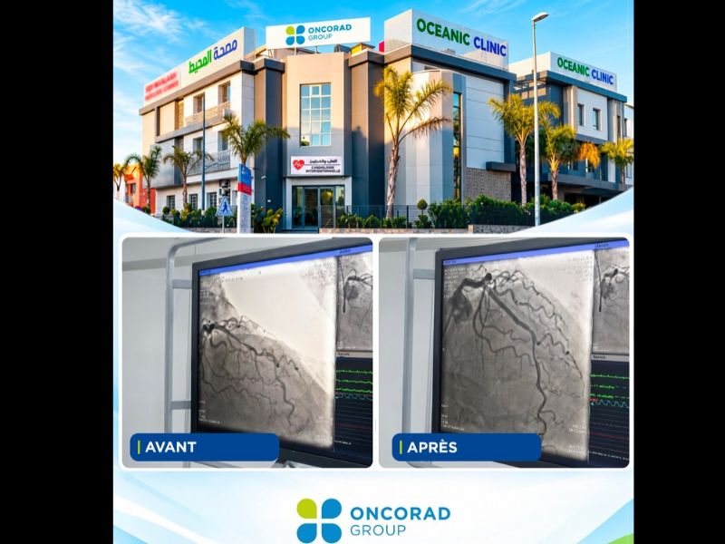 Cardiologie : OceanicClinic El Hana réalise une première lithotripsie intracoronaire à Casablanca
