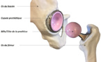 Le remplacement total de la hanche se fait en ambulatoire dans les pays du Maghreb