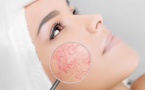 Couperose, des conseils pratiques pour éviter le préjudice esthétique
