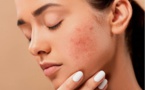 Couperose : comment apaiser au naturel ?