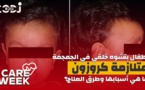 Care Week : أطفال بتشوه خلقي في الجمجمة، متلازمة كروزون،  ما هي أسبابها وطرق العلاج؟