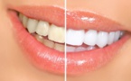 Éclaircissez votre sourire : Le guide complet du blanchiment dentaire