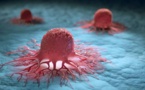 Cancer : l'OMS alerte sur une explosion des cas à l'horizon 2050