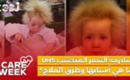 Care Week : ما هي أسبابها وطرق العلاج؟، UHS متلازمة الشعر المتخشب