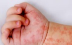 Rougeole au Maroc : retour d'une menace oubliée