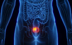 Cancer de la vessie : un virus courant serait-il en cause ?
