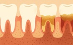 La Parodontite : une maladie silencieuse qui détruit les dents… 