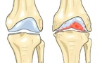 Traitement de l’arthrose : des résultats prometteurs pour une solution durable