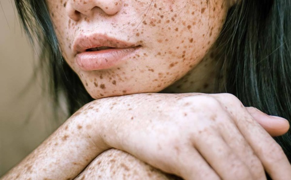 Soleil : Comment échapper aux tâches brunes ?