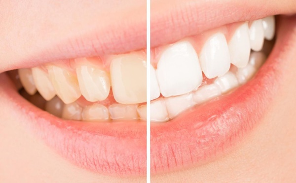  Comment blanchir ses dents sans les abîmer ?