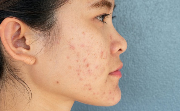 Beauté : Quels aliments donnent des boutons ?