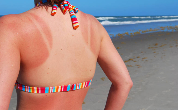 Bronzage : comment en profiter cet été sans se brûler la peau ?