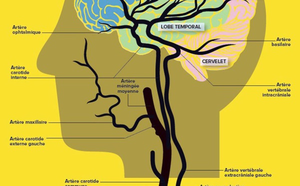 Quoi de neuf dans le traitement de l’Accident vasculaire cérébral en 2022