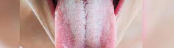 Pourquoi a-t-on parfois la langue blanche ?