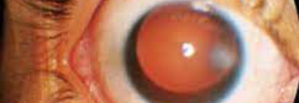 Connaissez-vous l'aniridie : ne pas avoir d'iris dans les yeux ?