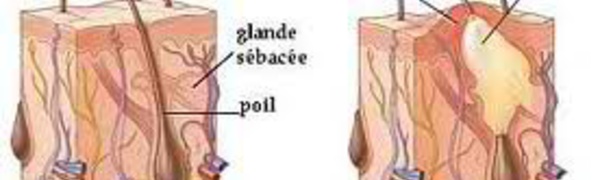 L’acné est causée par une surproduction de sébum. Mais qu'est-ce que le sébum ?