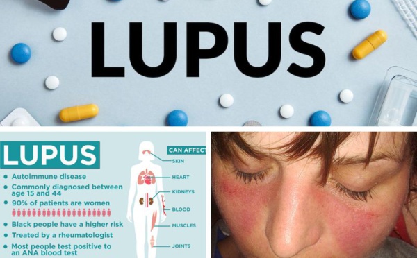 Le lupus, une maladie chronique auto-immune que l'on ne sait malheureusement pas guérir