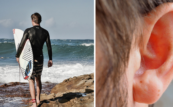 Exostose : Comprendre la maladie des surfeurs