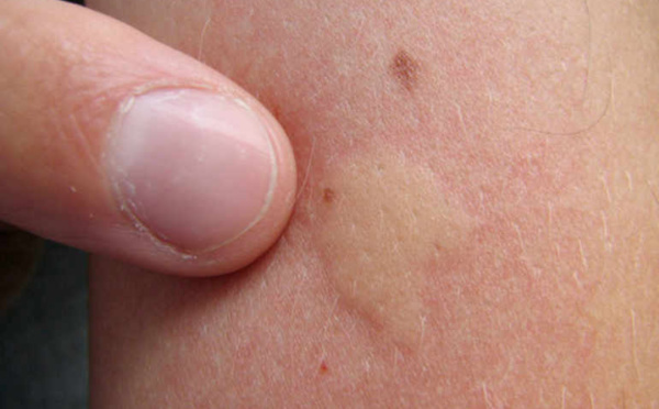 Nos amis les insectes sont parmi nous : que faire en cas de piqûre ?