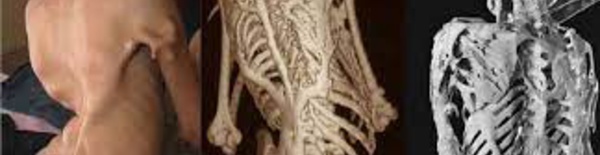 Patient bizarre : la maladie qui transforme les muscles en « pierre »