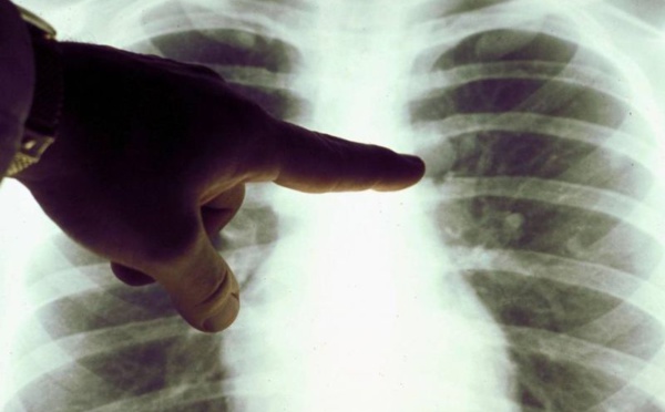 La tuberculose est encore persistante au Maroc