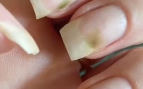 Le syndrome des ongles verts ?