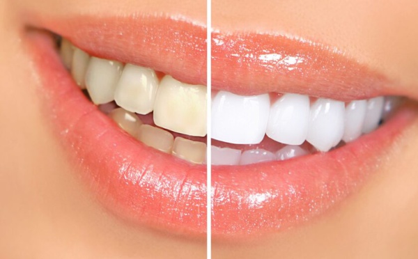 Éclaircissez votre sourire : Le guide complet du blanchiment dentaire