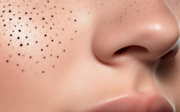 Attention, il ne faut pas retirer soit même les points noirs