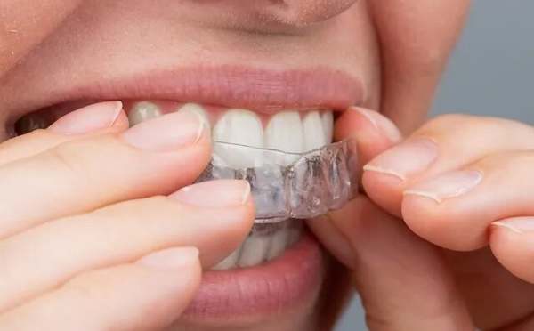 Les avancées en orthodontie invisible