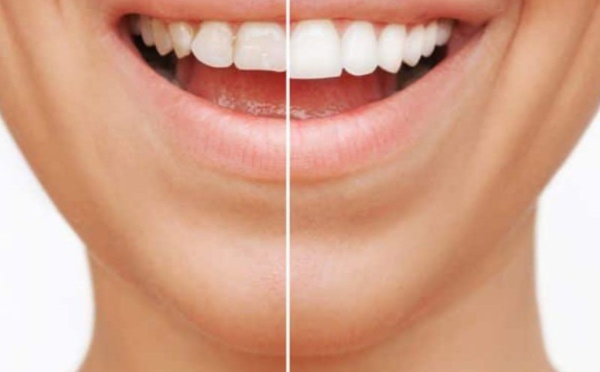 Les traitements esthétiques dentaires