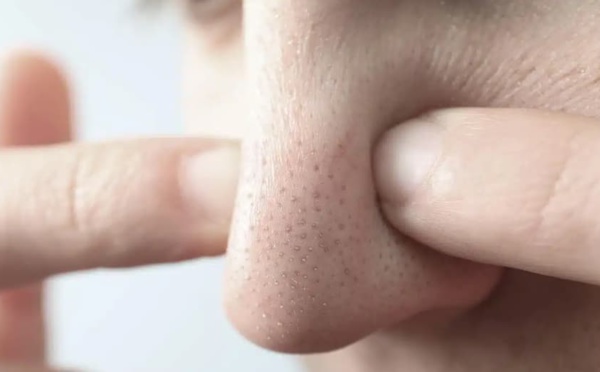 Comment se débarrasser des points noirs sur le nez		