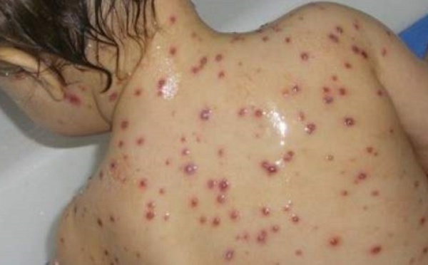 Rougeole à Chichaoua : Mobilisation générale des autorités pour sauver les enfants