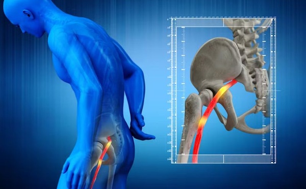 Entretien : La sciatique expliquée par un rhumatologue