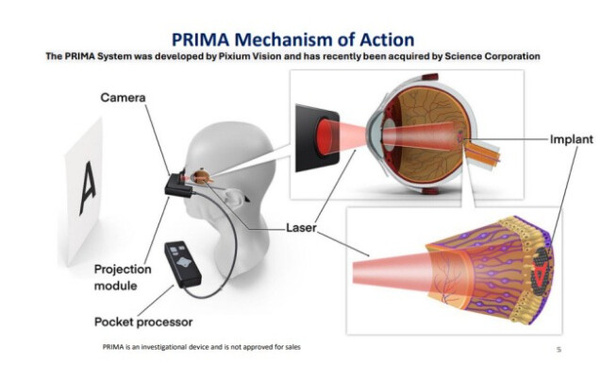 « Rendre la vue » n’est plus un rêve : l’implant rétinien qui redonne une vision centrale aux patients DMLA