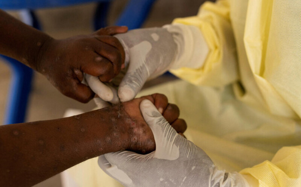 Choléra et Mpox : plus de 8.000 morts en Afrique depuis janvier