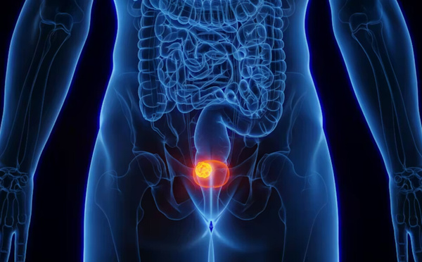 Cancer de la vessie : un virus courant serait-il en cause ?