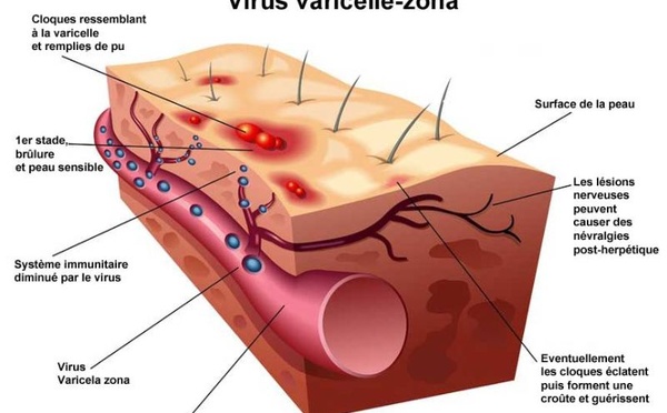 Le Zona : quand un virus endormi se réveille et transforme le corps en champ de bataille