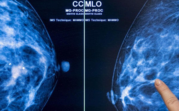 L’IA prédit le risque de cancer du sein plusieurs années à l’avance