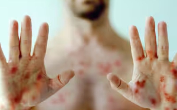 Mpox à New York : un seul cas, mais un signal que la santé publique ne peut pas traiter à la légère