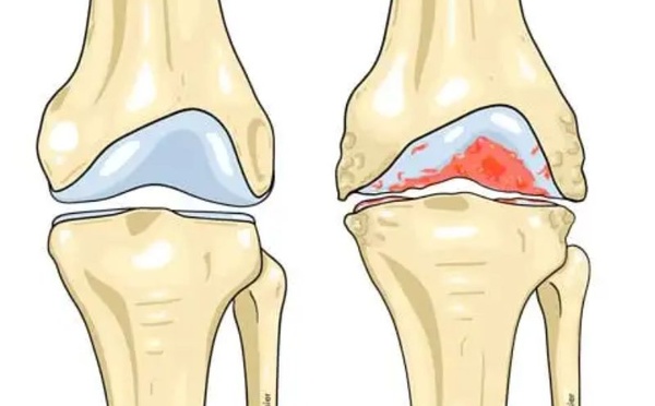Traitement de l’arthrose : des résultats prometteurs pour une solution durable