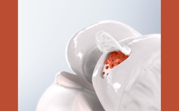 La laine : un nouvel allié pour la régénération osseuse en médecine