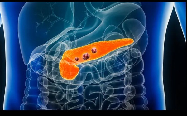 Un nouveau médicament expérimental double le taux de survie des patients atteints de cancer du pancréas