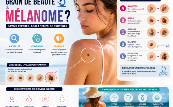 Comment distinguer un grain de beauté d’un mélanome ?
