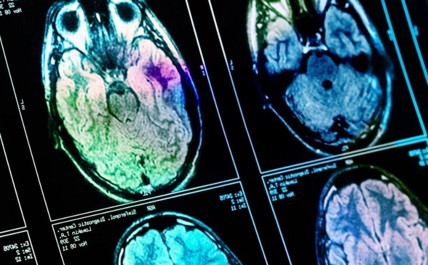 Une glycémie élevée pourrait accélérer le vieillissement du cerveau, selon une étude