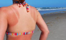 Bronzage : comment en profiter cet été sans se brûler la peau ?
