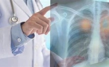 Pollution : La compréhension du cancer du poumon fait une avancée majeure