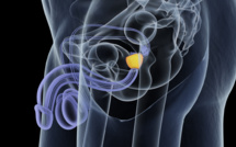 Problémes de prostate ! 10 questions à votre médecin